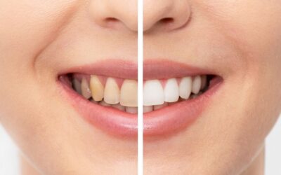 DIY Teeth Whitening Hacks Are Everywhere. Here’s What to Know Before You Try One